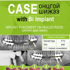 Bi Implant (the case)
