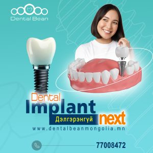Bi Implant