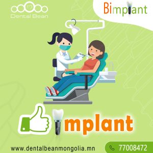 Bi Implant